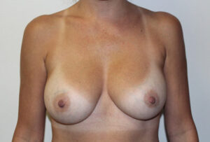 Breast Implant Removal