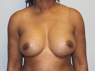 Breast Implant Removal