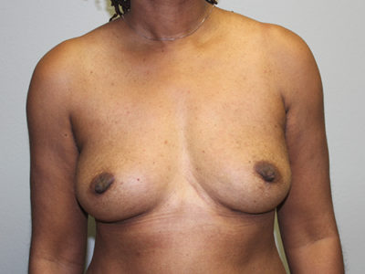 Breast Implant Removal