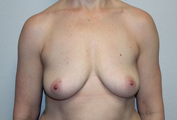 Breast Implant Removal