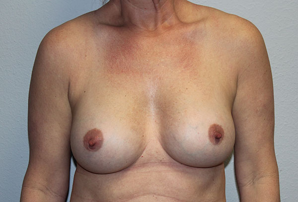 Breast Implant Removal