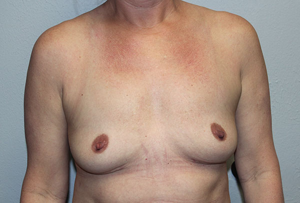 Breast Implant Removal