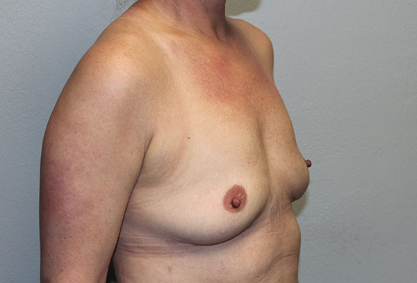 Breast Implant Removal