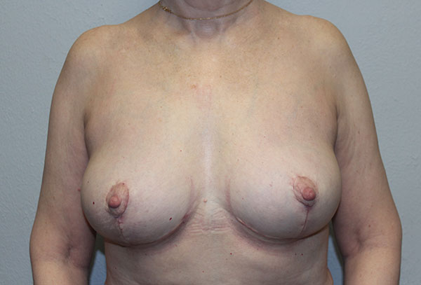 Breast Implant Removal